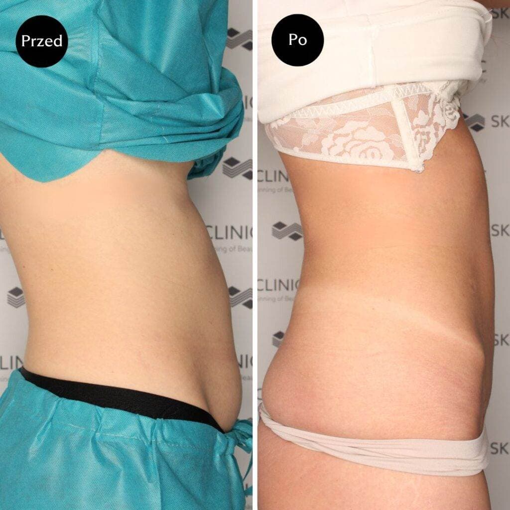 Efekt modelowania sylwetki – zdjęcia przed i po w klinice SkyClinic