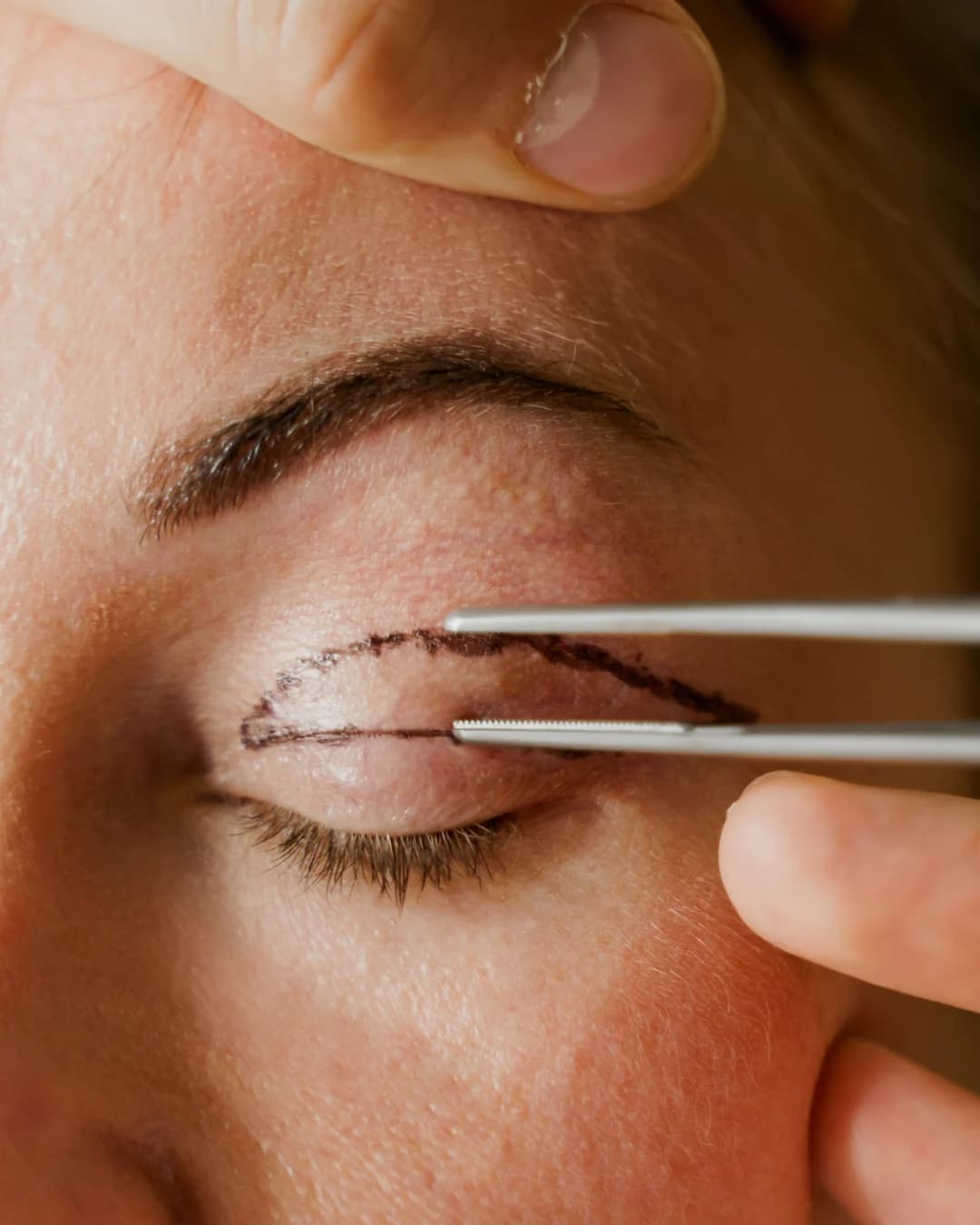 Lekarz wyznacza linie cięcia na powiece górnej przed blefaroplastyką - SkyClinic Warszawa