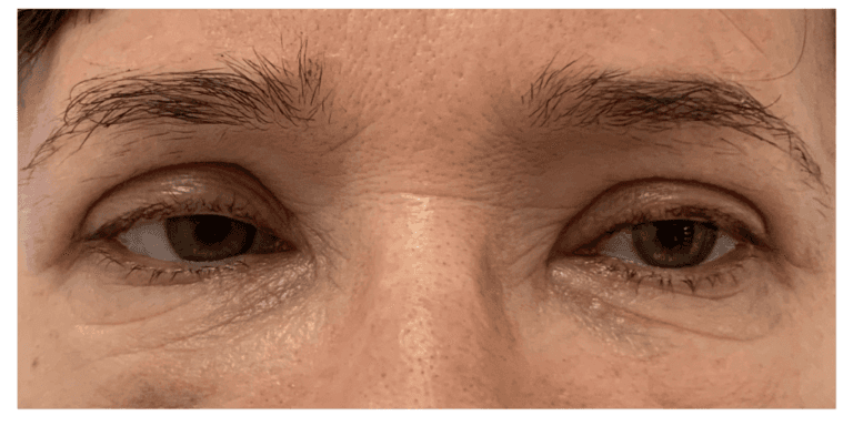 Blefaroplastyka, pacjent 02: po zabiegu