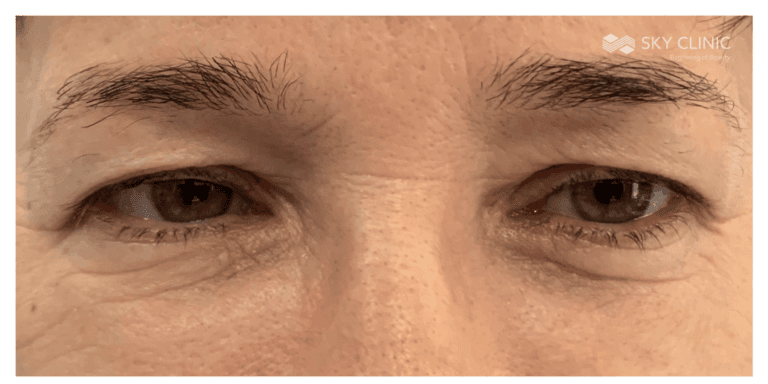 Blefaroplastyka, pacjent 02: przed zabiegiem