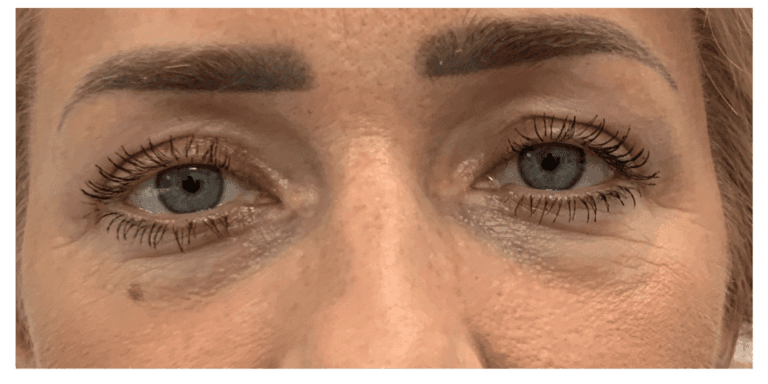 Blefaroplastyka, pacjent 03: po zabiegu