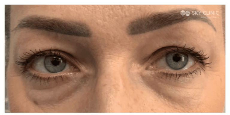 Blefaroplastyka, pacjent 03: przed zabiegiem