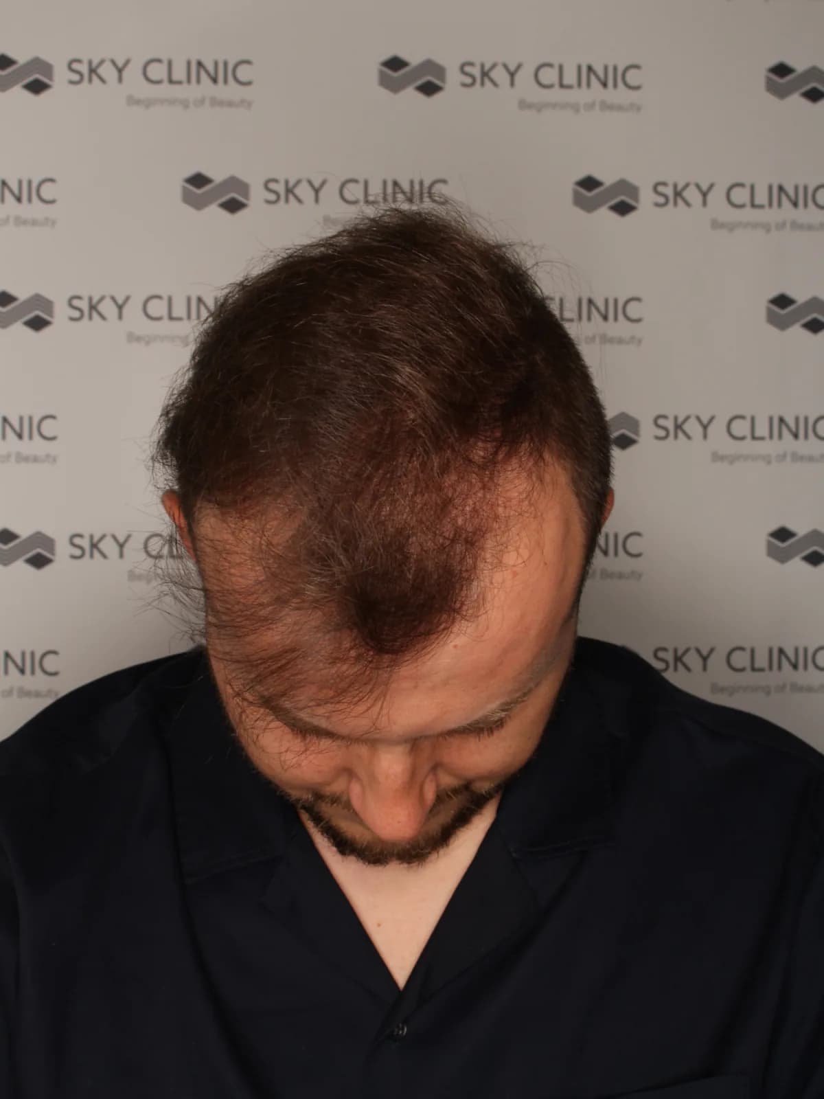 Stan przed zabiegiem przeszczepu włosów, pacjent 01 - SkyClinic