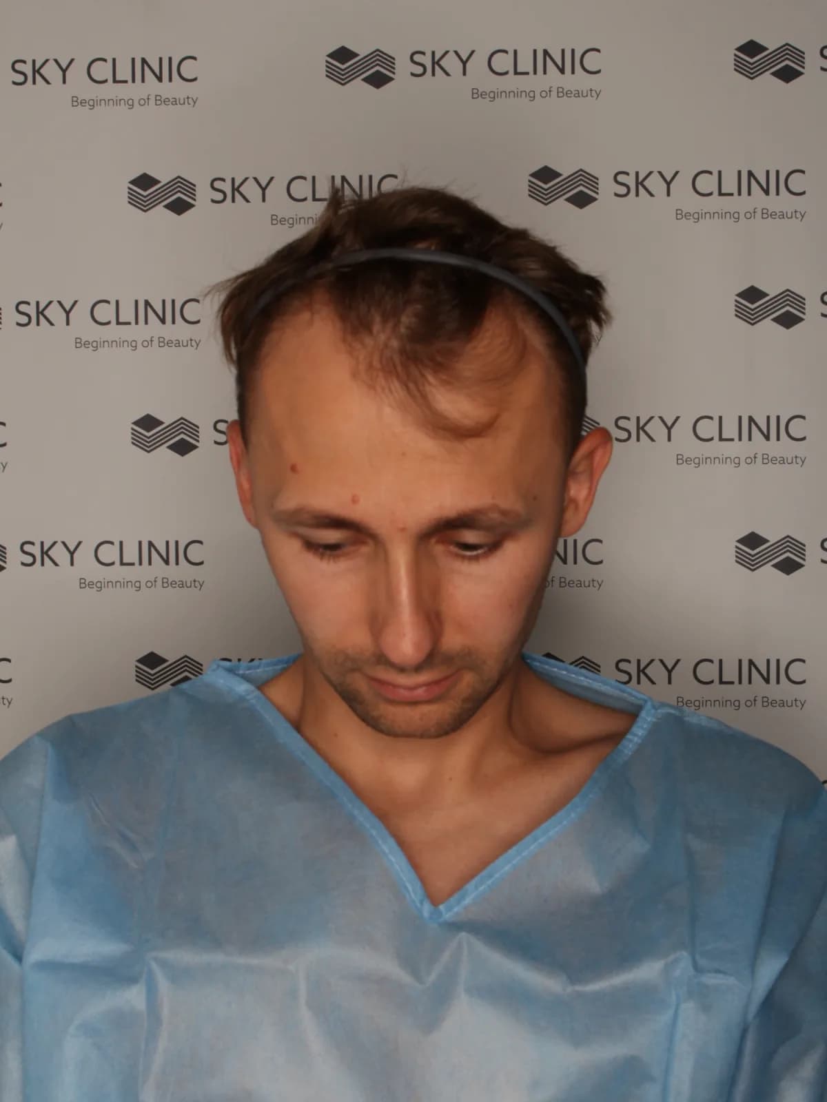 Pacjent 04, stan przed przeszczepem włosów