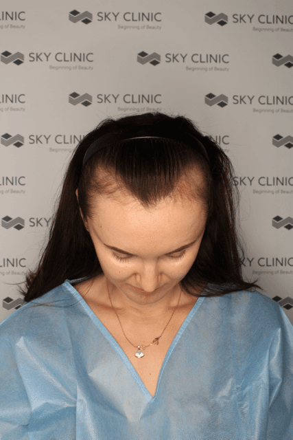 Pacjentka SkyClinic - przerzedzona linia włosów u kobiety, kwalifikacja do przeszczepu