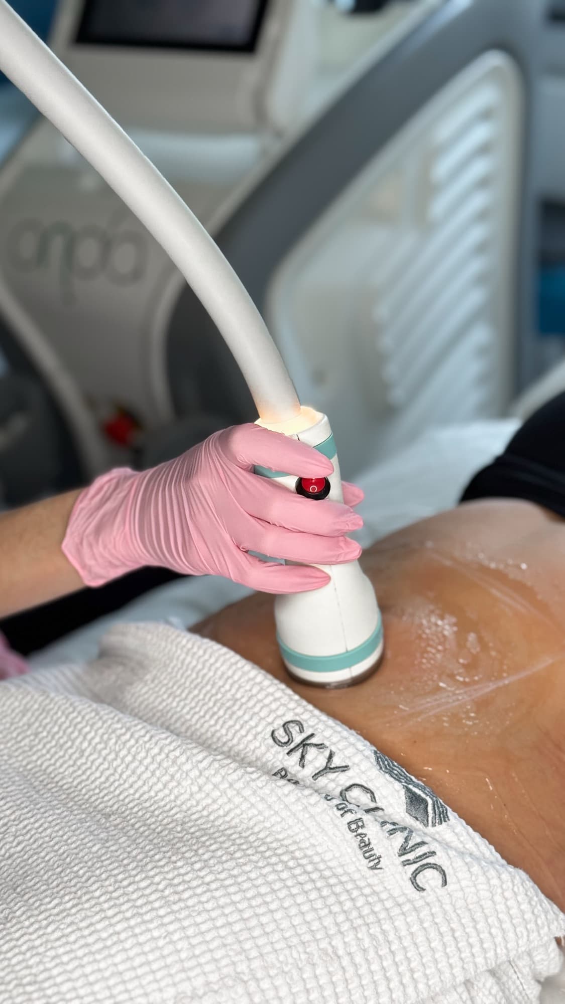 Zabieg Onda na brzuch urządzeniem Coolwaves w SkyClinic