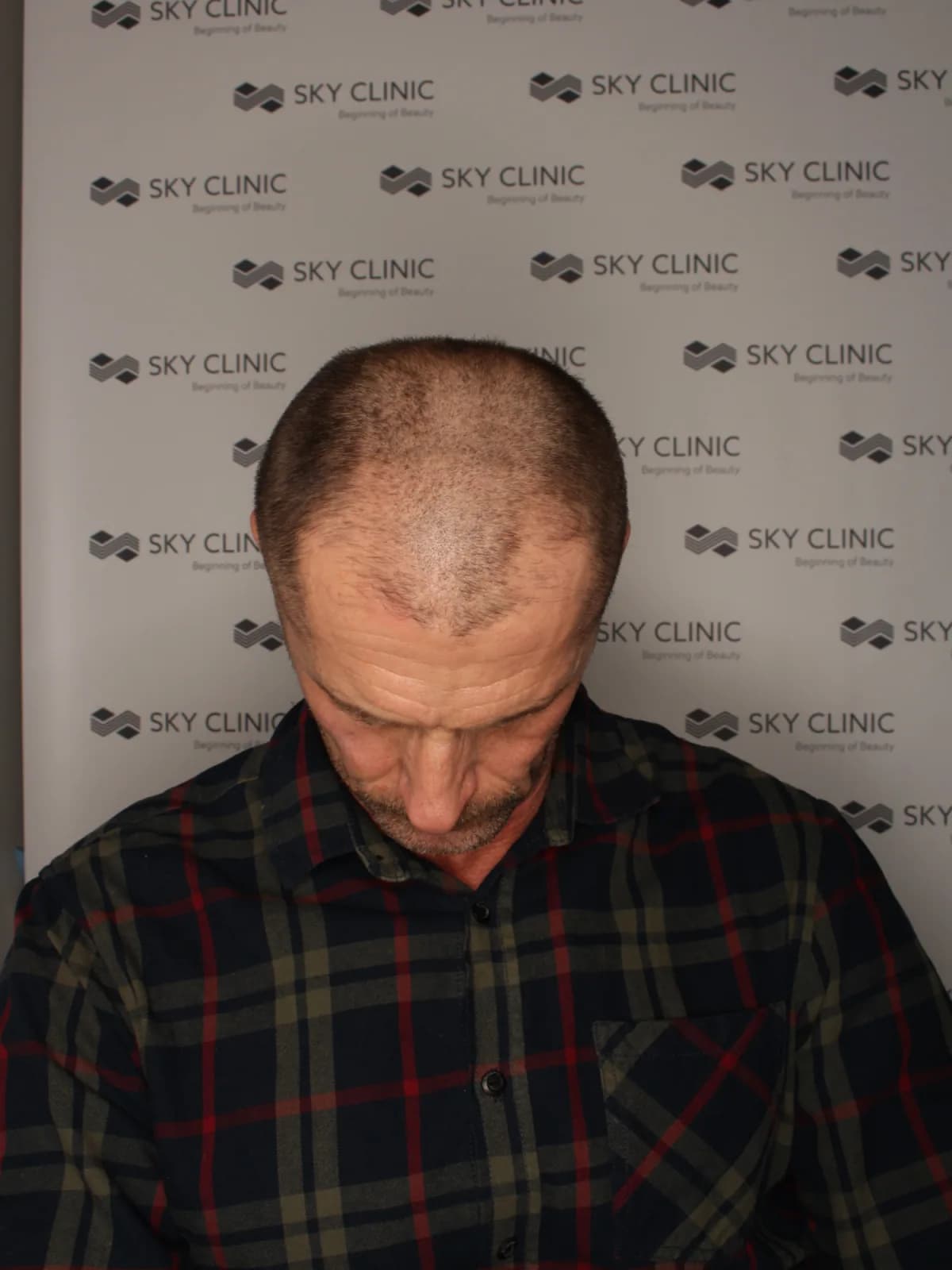 Stan przed zabiegiem przeszczepu włosów, pacjent 01 - SkyClinic